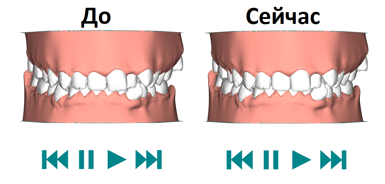 Aligners. Second pair. 1-13 days of wear - Personal experience, My, Aligners, Bite correction, Malocclusion