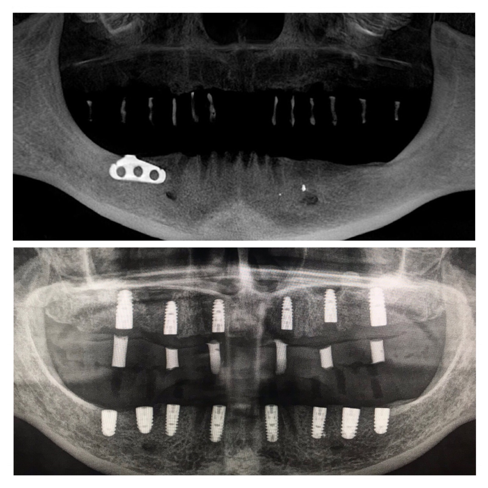 Базальная имплантация. Базальные импланты ОПТГ. Ортопантомограмма имплантация. Имплантация рентген ортопантомограмма.