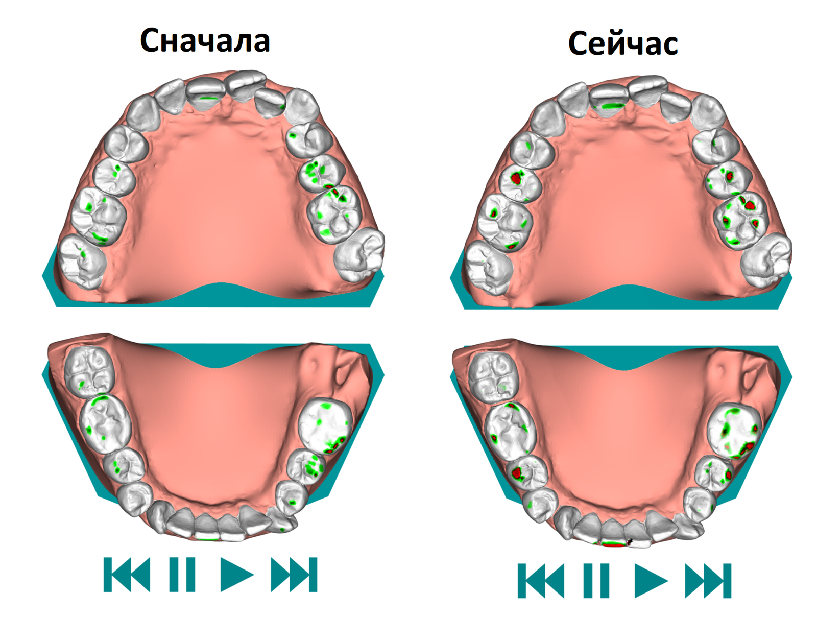 Aligners. Seventh pair. 1-11 days of wear - My, Aligners, Malocclusion, Bite correction, Personal experience