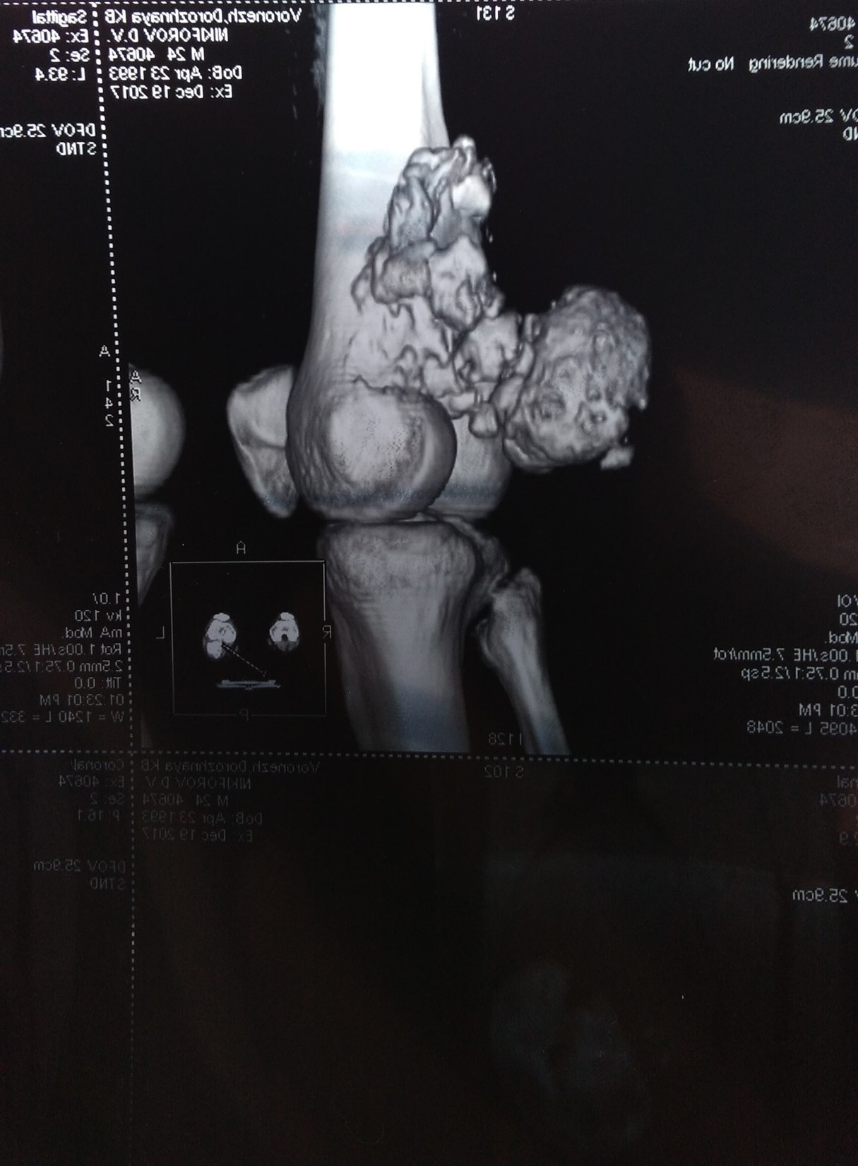 Endoprosthesis or how I became a cyborg! - My, Endoprosthetics, Sarcoma, Joints, The medicine, Longpost, Text