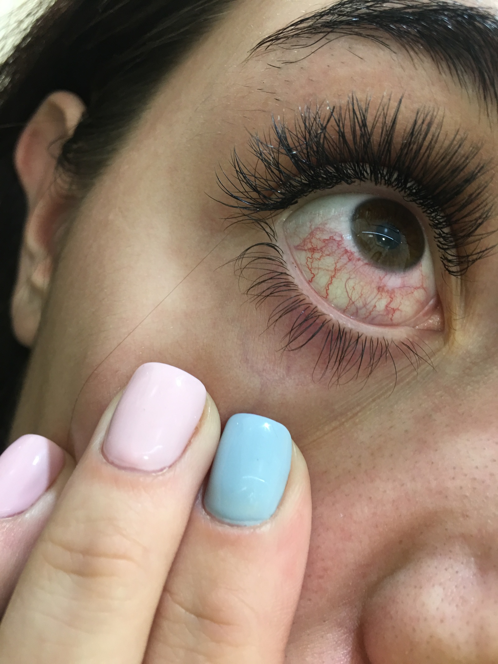 Красные глаза после наращивания ресниц: от чего и как лечить
