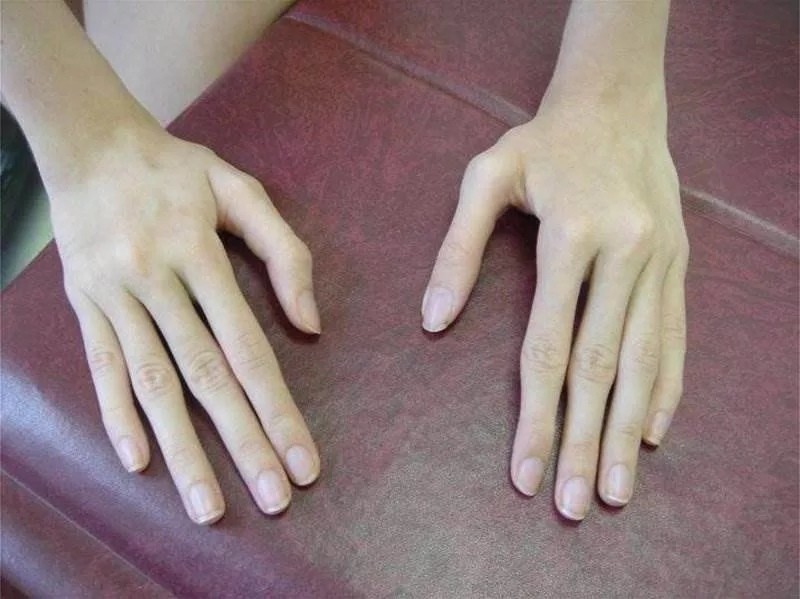 Arachnodactyly (literally spider fingers) - Pathology, Anatomy, Longpost