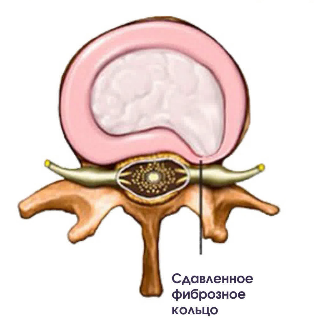 NOT a terrible hernia - My, The medicine, Hernia, Spine, Longpost