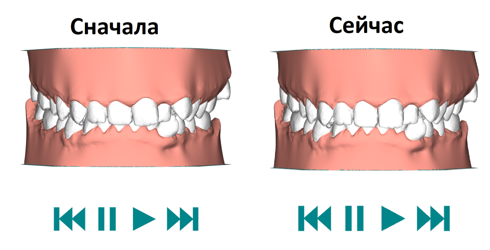 Aligners. 12 pair. - My, Aligners, Bite correction, Malocclusion, Personal experience, Longpost