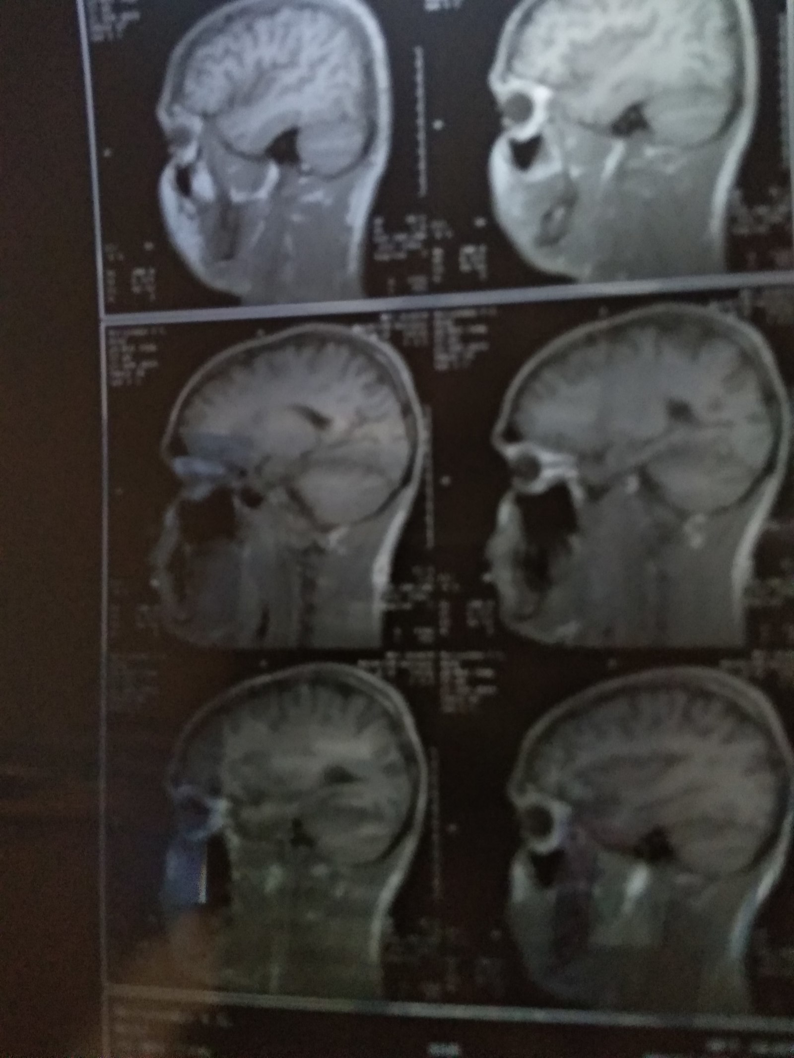 MRI of the brain. Cyst - My, Cyst, MRI, Doctors, Neurosurgery, The medicine, Longpost