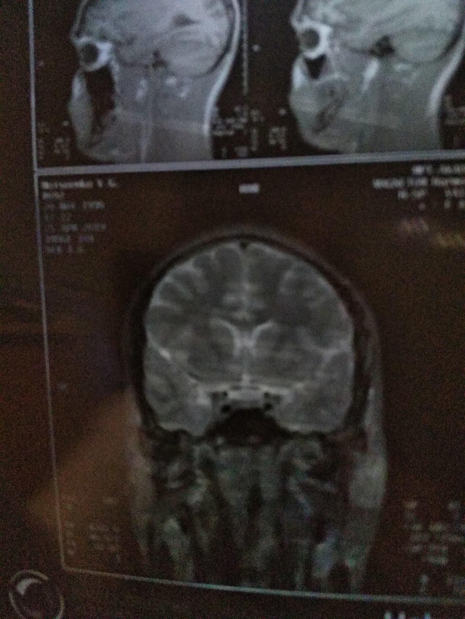 MRI of the brain. Cyst - My, Cyst, MRI, Doctors, Neurosurgery, The medicine, Longpost