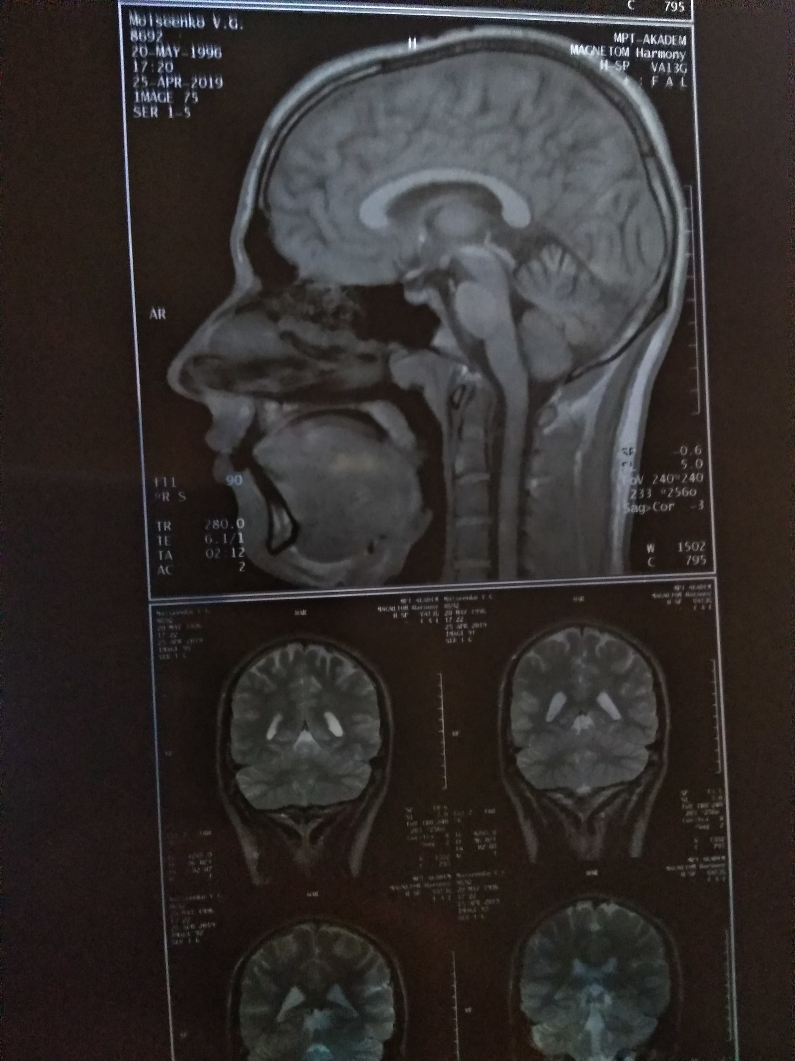 MRI of the brain. Cyst - My, Cyst, MRI, Doctors, Neurosurgery, The medicine, Longpost