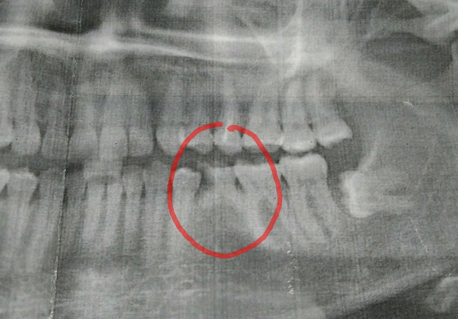 Baby tooth - My, Dentistry, Baby teeth, X-rays, X-ray