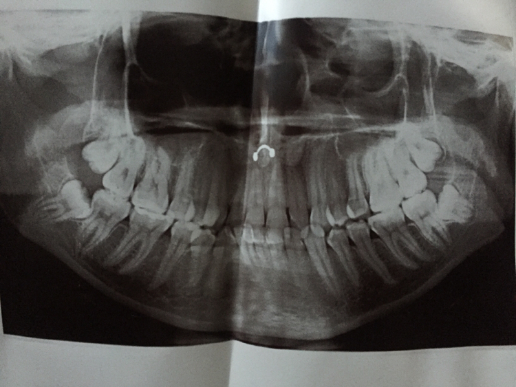 Speaking of piercings and x-rays - My, X-ray, Jaw, Septum