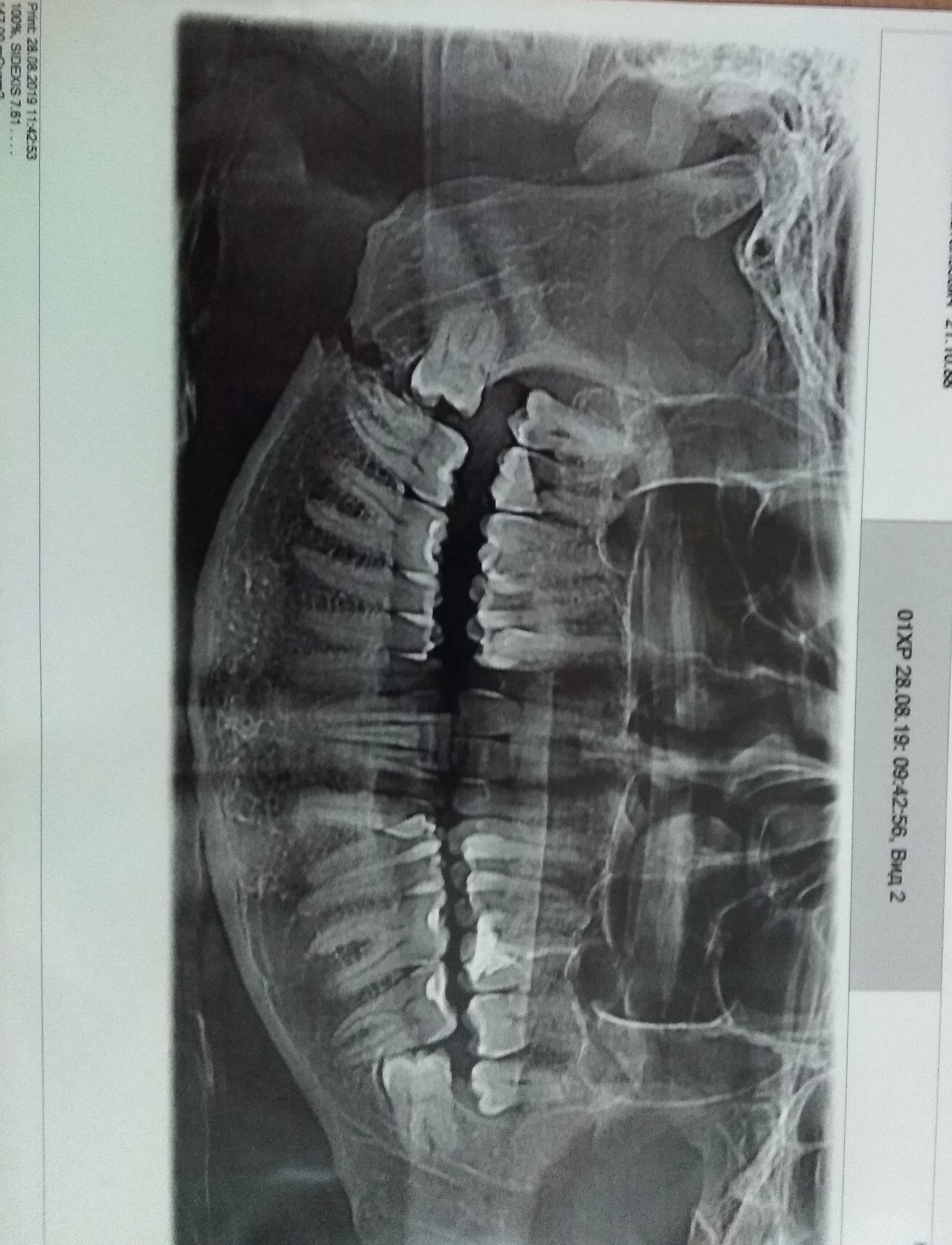 How do I remove my wisdom tooth? - My, Dentist, Wisdom tooth, Jaw fracture, Longpost