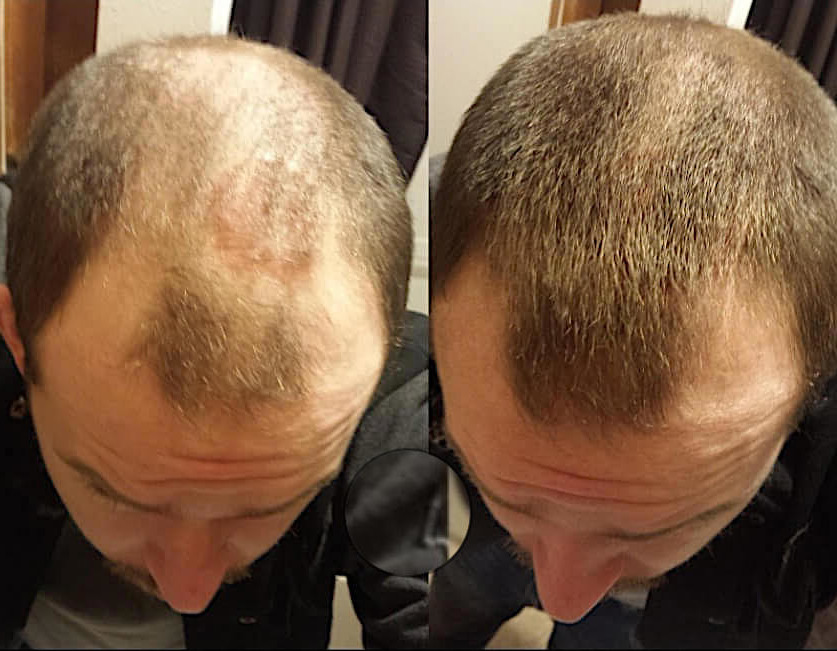 What to do when your hair is thinning. Thickeners - My, Hair, Baldness, Hair Transplant, beauty, Appearance, Cosmetology, The hairdresser, Прическа, Video, Longpost