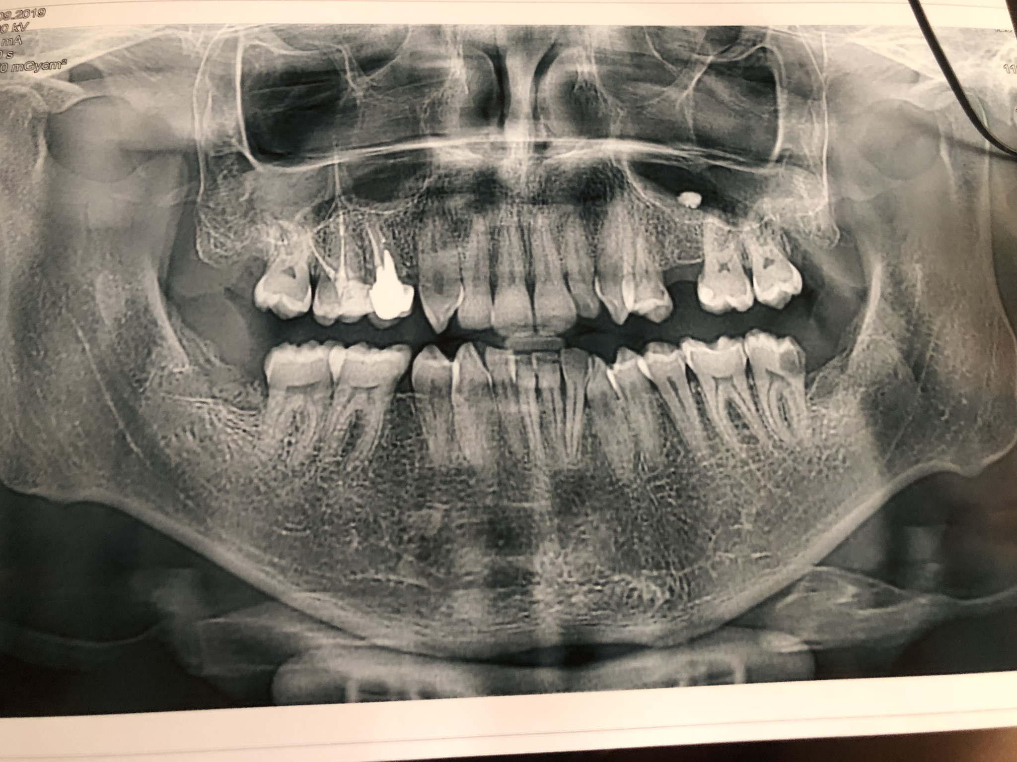 Maybe one of the dentists can tell - My, Teeth, Dentistry