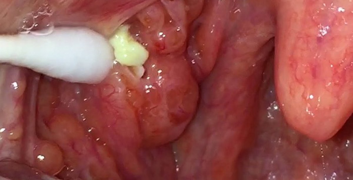 Как избавиться от пробок в горле: терапия тонзиллита